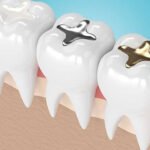 restoration-fillings